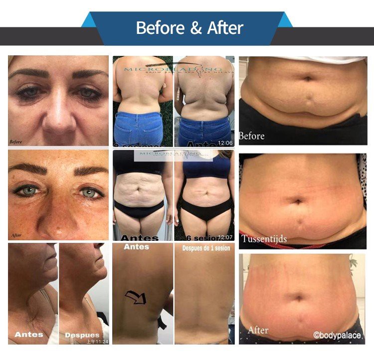 velashape before after photos 5